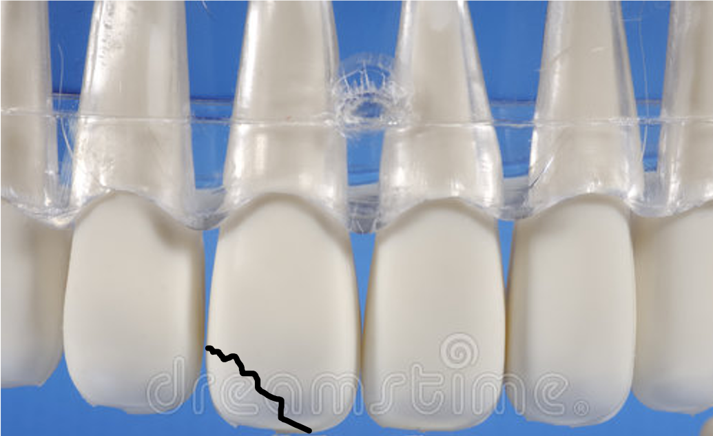 Tooth Fracture Trauma AtoothZ